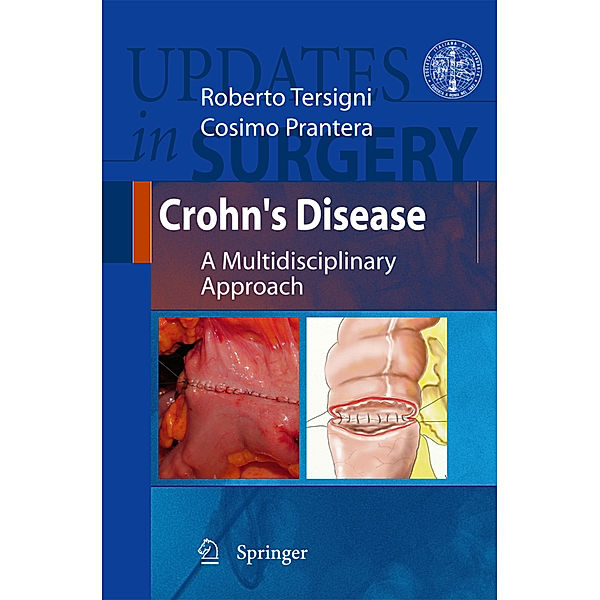 Crohn's Disease