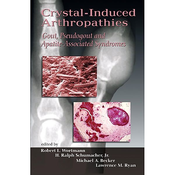 Crystal-Induced Arthropathies