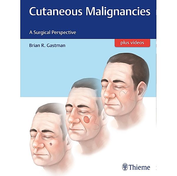 Cutaneous Malignancies