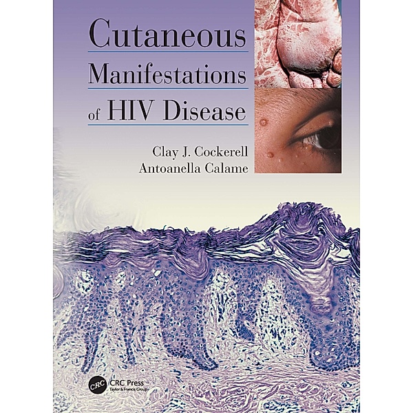 Cutaneous Manifestations of HIV Disease, Clay Cockerell, Antoanella Calame