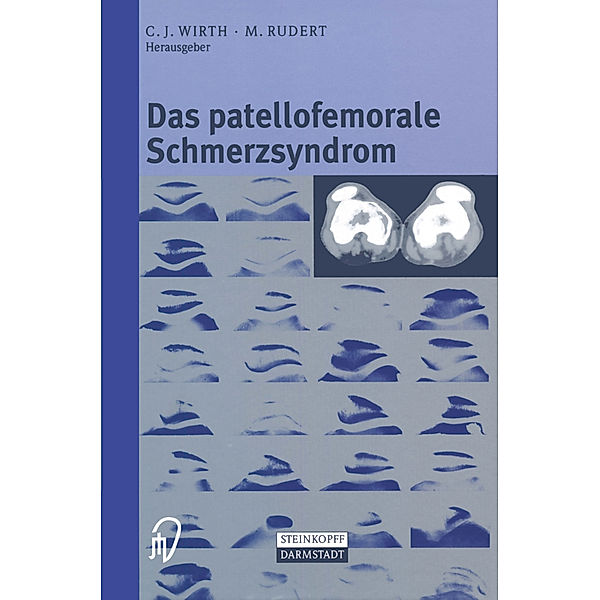 Das patellofemorale Schmerzsyndrom