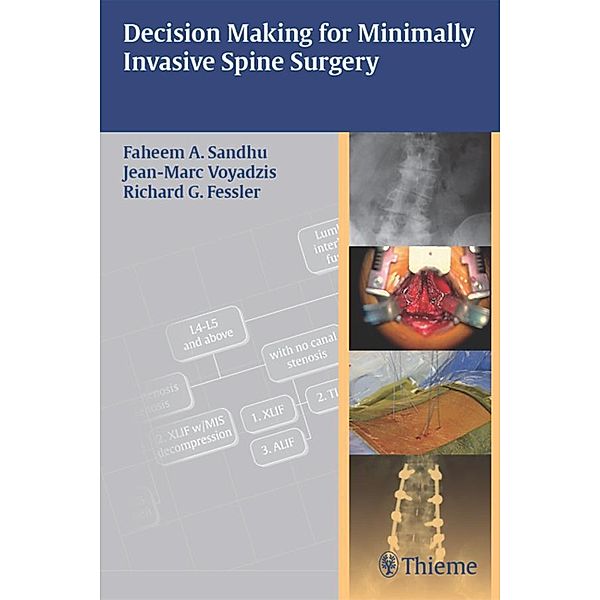 Decision Making for Minimally Invasive Spine Surgery