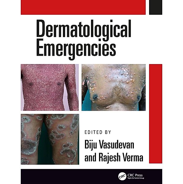 Dermatological Emergencies