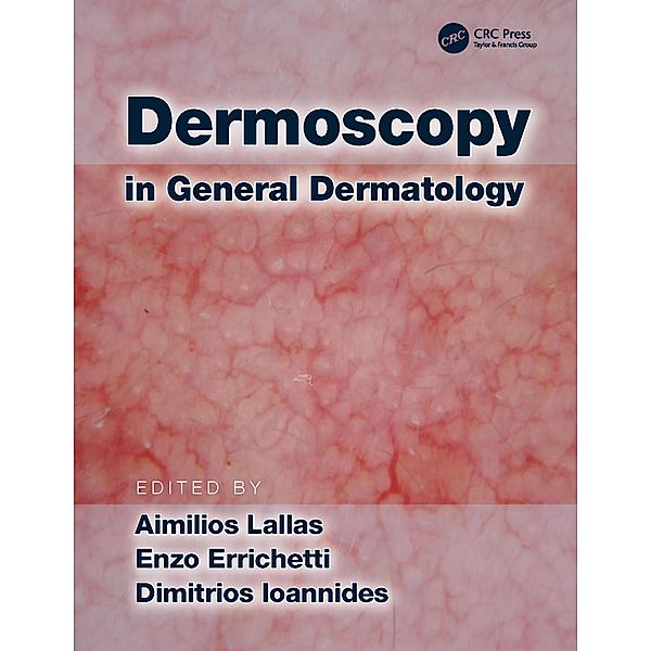 Dermoscopy in General Dermatology