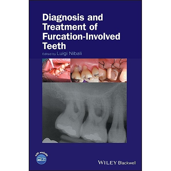 Diagnosis and Treatment of Furcation-Involved Teeth
