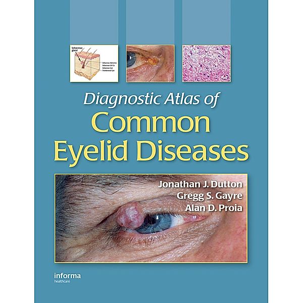 Diagnostic Atlas of Common Eyelid Diseases, Jonathan J. Dutton, Gregg S. Gayre, Alan D. Proia