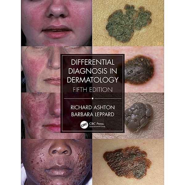 Differential Diagnosis in Dermatology, Richard Ashton, Barbara Leppard