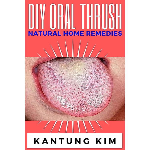 DIY Oral Thrush Natural Home Remedies, Kantung Kim