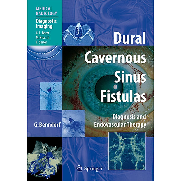 Dural Cavernous Sinus Fistulas, Goetz Benndorf