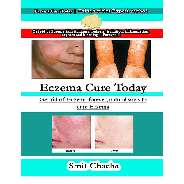 Eczema Cure Today: Get Rid of Eczema Forever, Natural Ways to Cure Eczema, Smit Chacha
