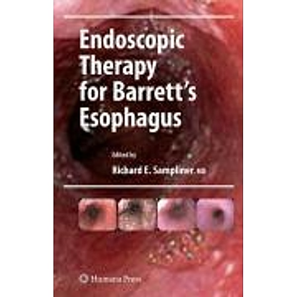 Endoscopic Therapy for Barrett's Esophagus / Clinical Gastroenterology