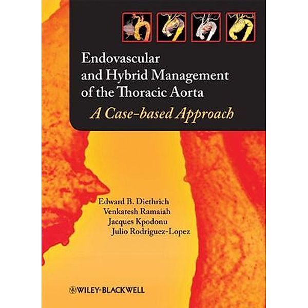 Endovascular Management of the Thoracic Aorta, Edward B. Diethrich, Venkatesh Ramaiah, Jacques Kpodonu, Julio A. Rodriguez-Lopez