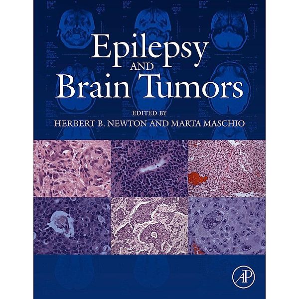 Epilepsy and Brain Tumors