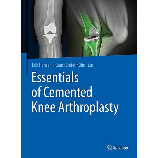 Essentials of Cemented Knee Arthroplasty