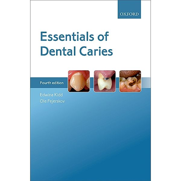 Essentials of Dental Caries, Edwina Kidd, Ole Fejerskov