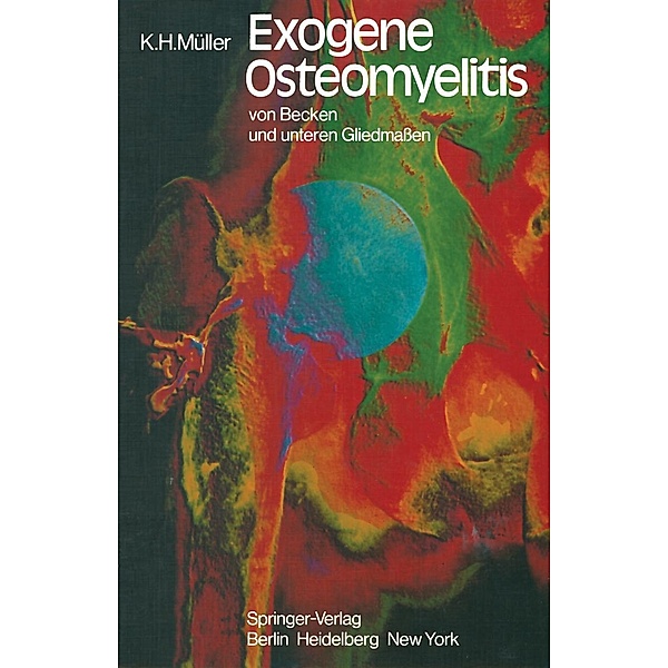 Exogene Osteomyelitis von Becken und unteren Gliedmassen, K. H. Müller