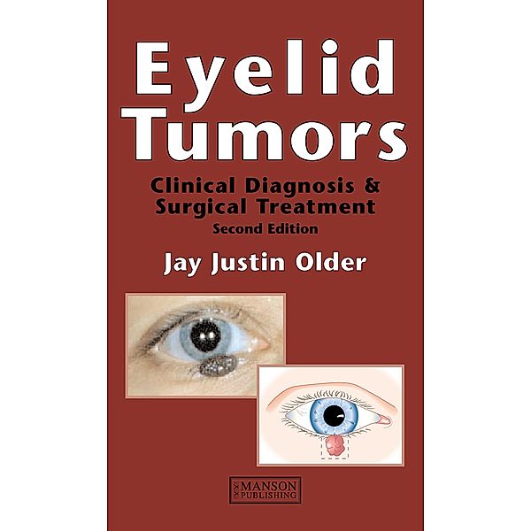 Eyelid Tumors, Jay Justin Older