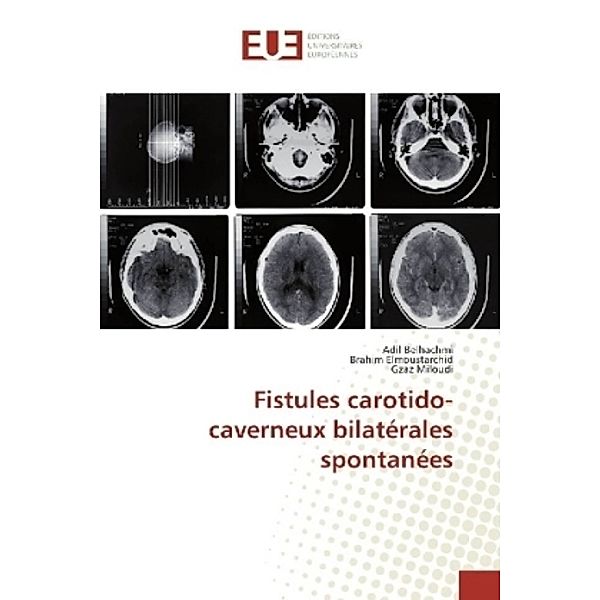 Fistules carotido-caverneux bilatérales spontanées, Adil Belhachmi, Brahim Elmoustarchid, Gzaz Miloudi