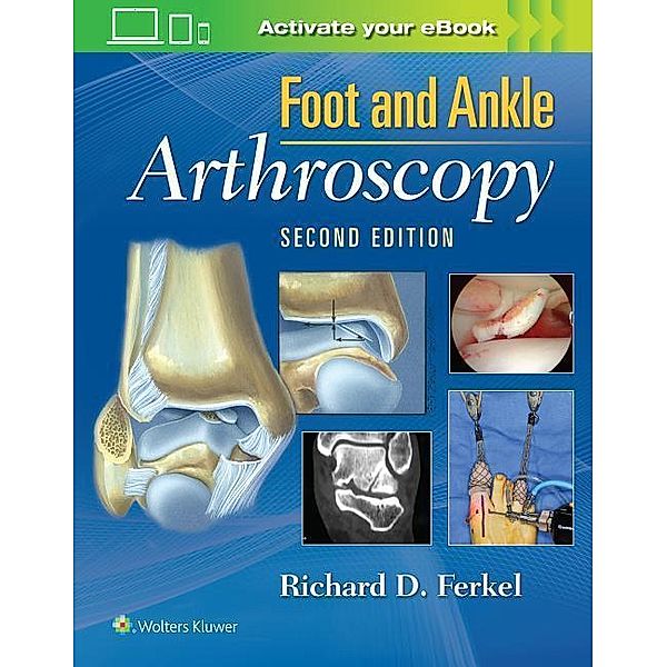 Foot & Ankle Arthroscopy, 2 Vols., Richard D. Ferkel