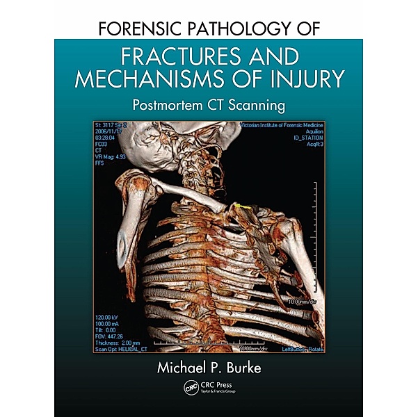 Forensic Pathology of Fractures and Mechanisms of Injury, Michael P. Burke