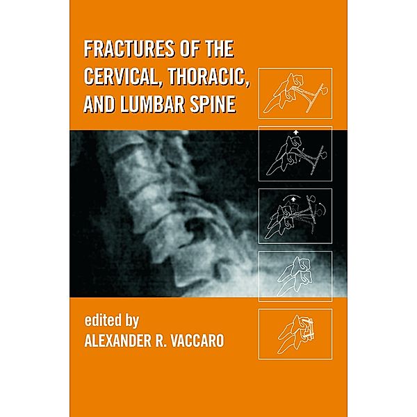 Fractures of the Cervical, Thoracic, and Lumbar Spine, Alexander R. Vaccaro