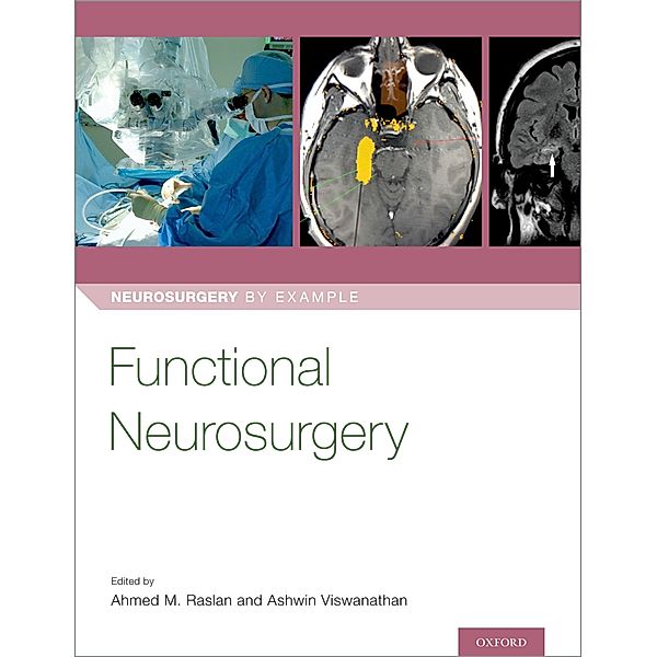 Functional Neurosurgery