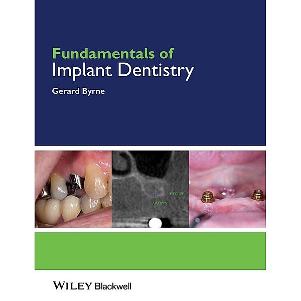 Fundamentals of Implant Dentistry / Fundamentals (Dentistry), Gerard Byrne