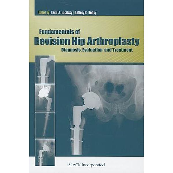 Fundamentals of Revision Hip Arthroplasty: Diagnosis, Evaluation, and Treatment