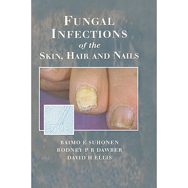Fungal Infections of the Skin and Nails, Raimo E. Suhonen, Rodney P. R. Dawber, David H. Ellis