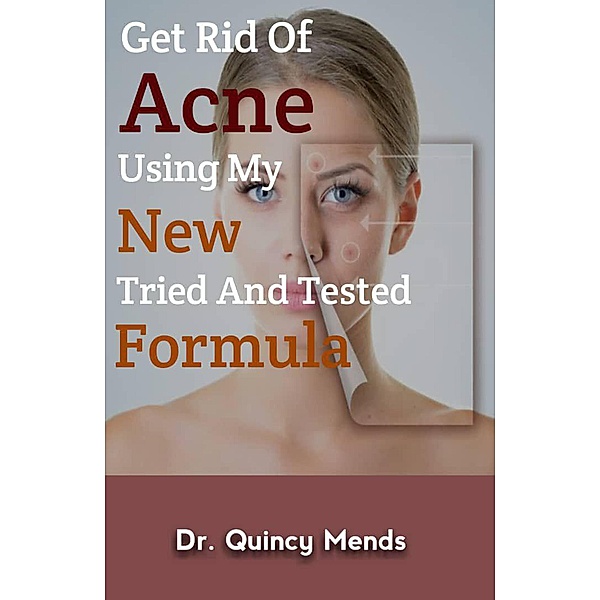 Get rid of acne using my new tried and tested formula, Quincy Mends