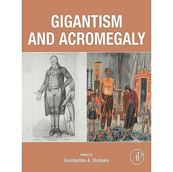 Gigantism and Acromegaly
