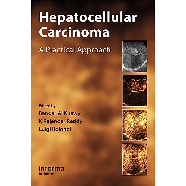 Hepatocellular Carcinoma