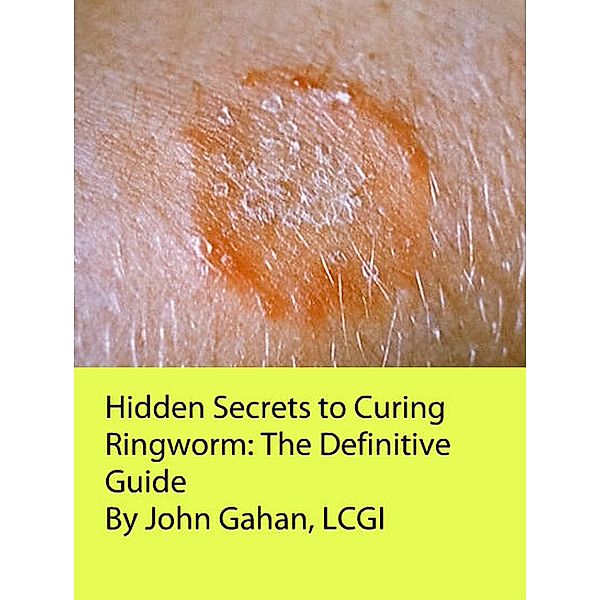Hidden Secrets to Curing Ringworm: The Definitive Guide, John Gahan