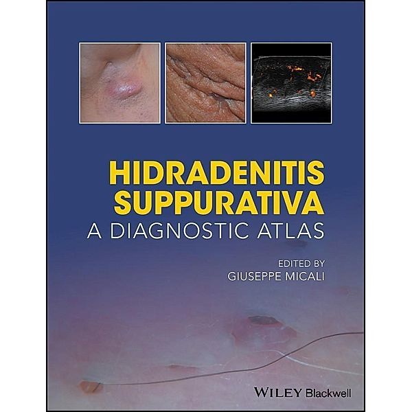 Hidradenitis Suppurativa