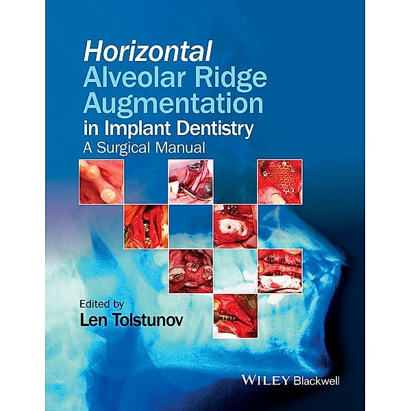 Horizontal Alveolar Ridge Augmentation in Implant Dentistry, Len Tolstunov
