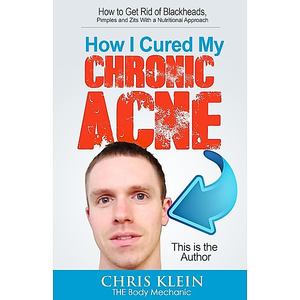 How I Cured My Chronic Acne: How to Get Rid of Blackheads, Pimples and Zits With a Nutritional Approach, Chris Klein