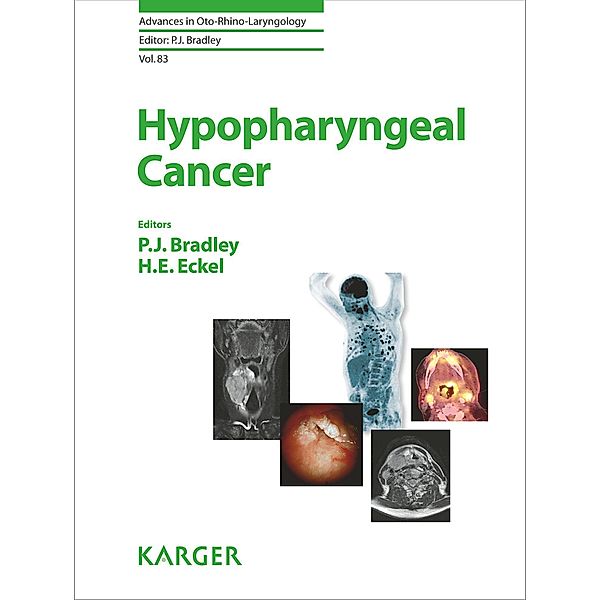 Hypopharyngeal Cancer