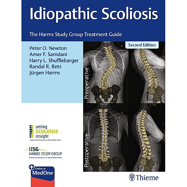 Idiopathic Scoliosis