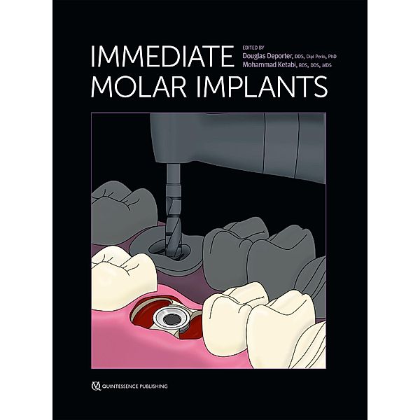 Immediate Molar Implants, Douglas Deporter, Mohammad Ketabi