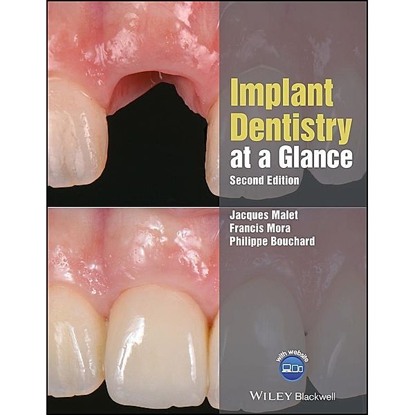 Implant Dentistry at a Glance / At a Glance (Dentistry), Jacques Malet, Francis Mora, Philippe Bouchard