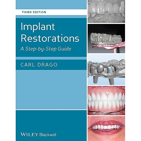 Implant Restorations, Carl Drago