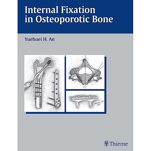 Internal Fixation in Osteoporotic Bone