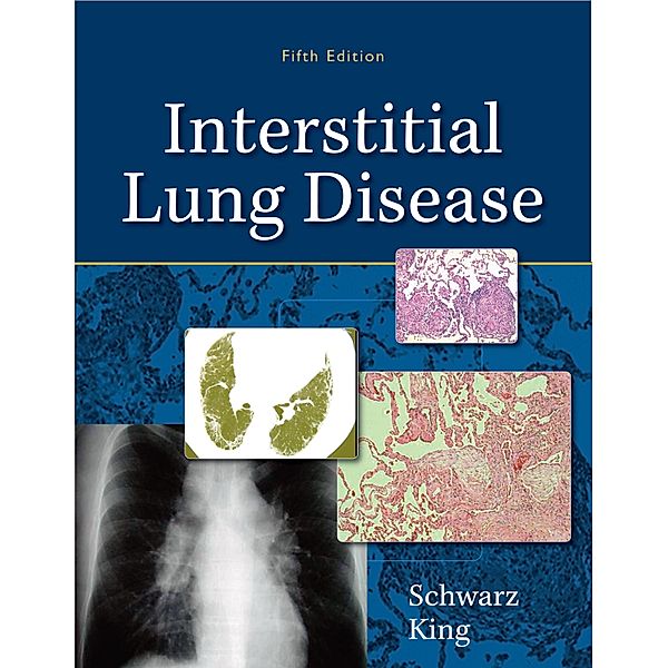 Interstitial Lung Disease