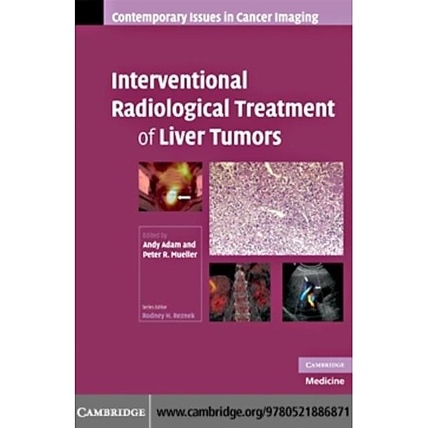 Interventional Radiological Treatment of Liver Tumors