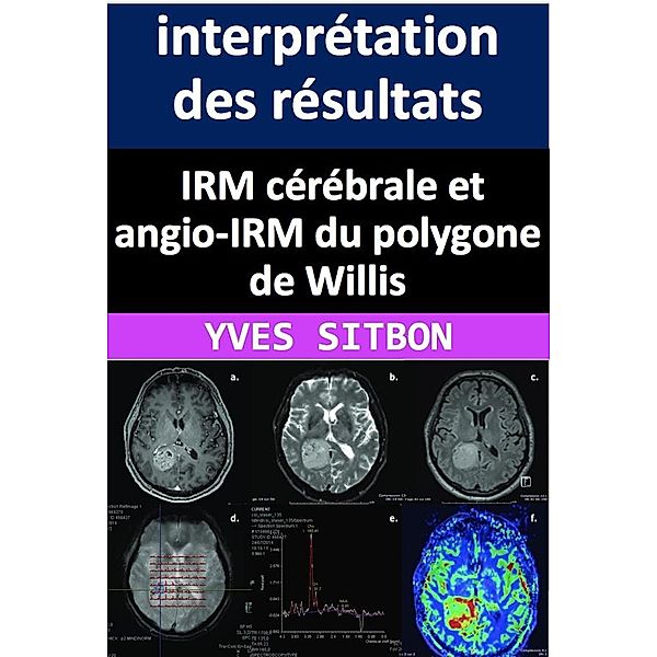 IRM cérébrale et angio-IRM du polygone de Willis : interprétation des résultats et implications cliniques., Yves Sitbon