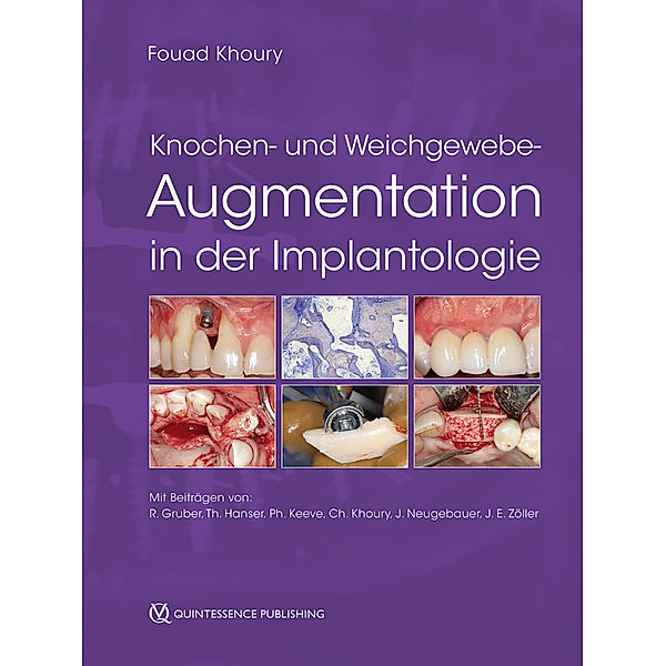 Knochen- und Weichgewebeaugmentation in der Implantologie