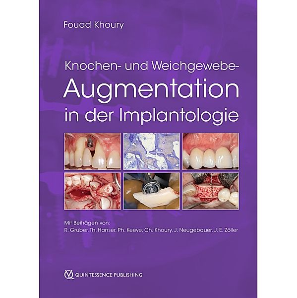 Knochen- und Weichgewebeaugmentation in der Implantologie