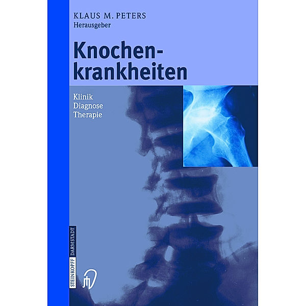 Knochenkrankheiten