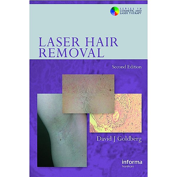 Laser Hair Removal