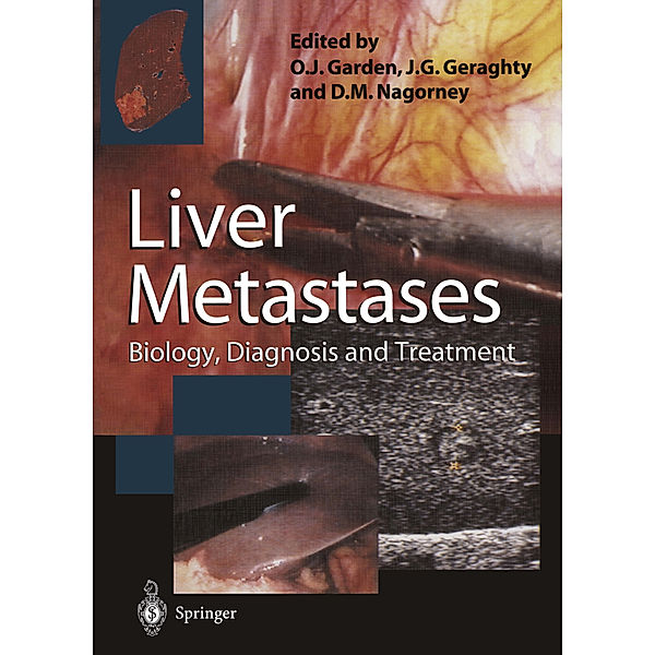 Liver Metastases